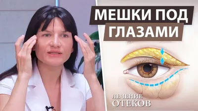 как убрать отеки под глазами, грыжи и малярные мешки. омоложение глаз -  YouTube