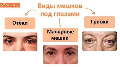 Как убрать мешки под глазами? | Микрохирургия глаза Василия Шевчика