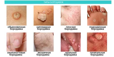 Лазерное удаление папиллом, фибром в Brenner Laser Clinic