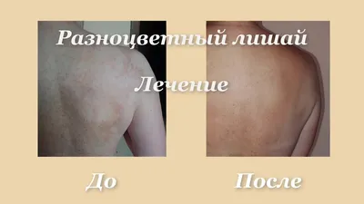 Pediatric outpatient clinic - Отрубевидный (разноцветный) лишай (Pityriasis  versicolor, альт. — Tinea versicolor) Бытовое название:«солнечный грибок».  Очень часто появление этого заболевания замечают после пребывания на  солнце. Разноцветный лишай ...