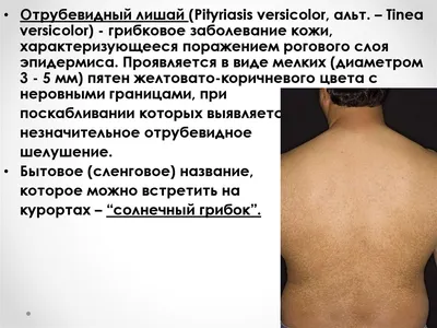 Лечение лишая на коже у взрослых: симптомы, разновидности, стоимость  лечения - Медицинский центр «Дезир» Санкт-Петербург.
