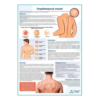 Лишай у человека на лице и теле | симптомы, причины, диагностика и лечение