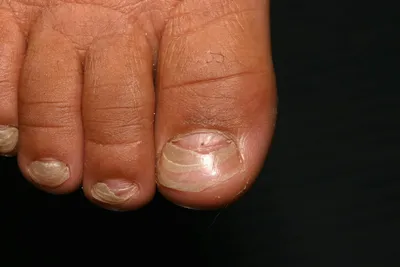 Онихомадезис – отслойка ногтя у основания, симптомы и причины, способы  лечения и профилактики