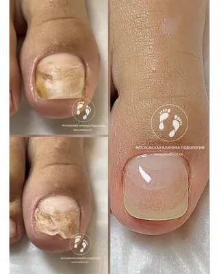Онихолизис и протезирование ногтей | Московская Клиника Подологии