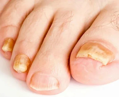 Пластины на ногти и скобы на ногти - лечение вросшего ногтя!