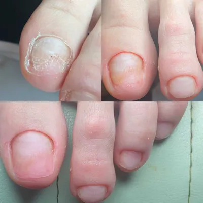 Отслоение ногтевой пластины | ООО «Медицинский центр «Здоровые стопы»
