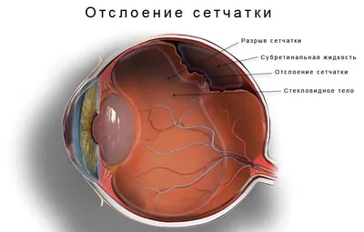 Отслоение сетчатки - МТК Микрохирургия глаза в Брянске