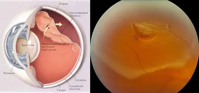 Отслоение сетчатки: что собой представляет патология и как ее устранить -  Офтальмологические клиники «Эксимер» (Киев) – диагностика и лечение  заболеваний глаз у взрослых и детей