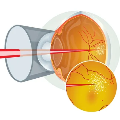 Отслоение сетчатки глаза: симптомы, причины, лечение, классификация  паталогии