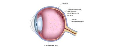 Отслойка сетчатки глаза: симптомы, диагностика, лечение, как проходит  операция и сколько она стоит