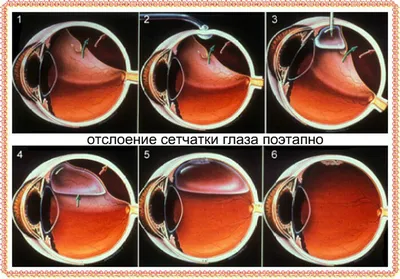 Отслойка сетчатки глаза - это тяжелейшее заболевание органа зрения, при  котором происходит отделение сетчатки от сосудистой… | Instagram