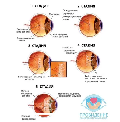 Отслоение сетчатки глаза: причины, симптомы, лечение, профилактика в  домашних условиях