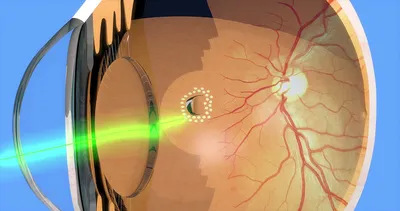 Отслойка сетчатки глаза, рассказывает офтальмохирург - Олег Унгурьянов |  Интернет-журнал Estetmedicina.ru