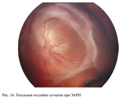 Разрыв сетчатки глаза - причины, симптомы, лечение
