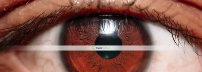 Виды отслойки сетчатки глаза, причины и методы лечения | Центр  микрохирургии глаза Макарчука - офтальмологический центр в Бресте