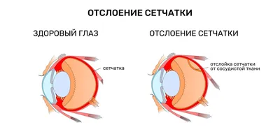 Отслойка сетчатки глаза лечение. Современное хирургическое лечение отслойки  сетчатки глаза