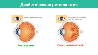 Эписклеральное пломбирование сетчатки глаза при ёё отслойке - цена операции