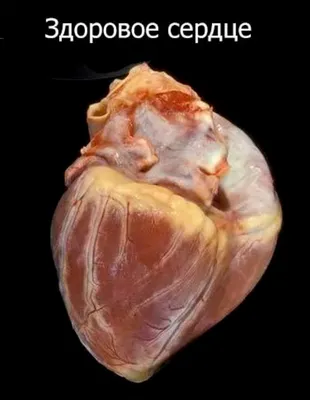 Ожирение сердца - Статьи от Правильной хирургии