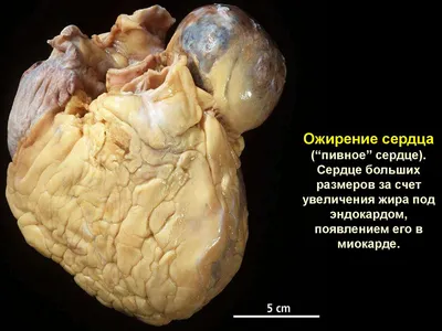 Ожирение снаружи и изнутри (7 фото)