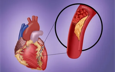 Как ожирение ухудшает состояние работы сердца: витамин А может помочь