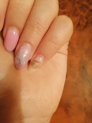 ❤ ОЖОГ от ЛАМПЫ ❤ ПРОДОЛЖЕНИЕ ❤ реконструкция ногтя ❤ РЕМОНТ ногтя ГИБКАЯ ❤  ЛЕНТА на ногтях ❤ - YouTube