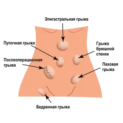 Межпозвоночная грыжа лечение в Одессе - нейрохирургия одного дня 2023 - ОМД  Клиника