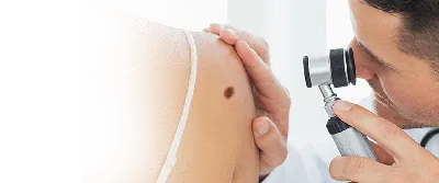 Грибковая инфекция в экземы дерматита псориазе паха. Стоковое Изображение -  изображение насчитывающей пах, трусливый: 173009403