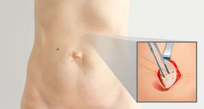 Сыпь на коже человека в районе паха концепция венерических заболеваний.  Стоковое Фото - изображение насчитывающей сыпь, зудяще: 204657352