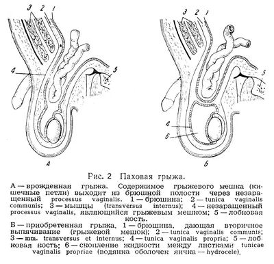 Паховая грыжа: виды, признаки, лечение | МедИнфо | Дзен