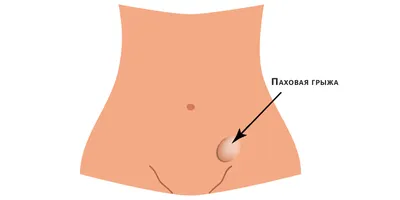 Паховая грыжа у детей: симптомы, причины и методы лечения | Название сайта