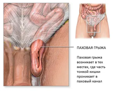 Паховая грыжа у ребёнка: это опасно? - Общество - Новости - Калужский  перекресток Калуга