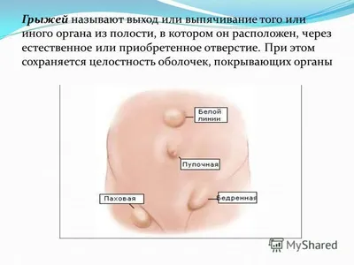 Хирургическое лечение мальчиков с грыжами пахового канала. Анализ  пятилетнего опыта – тема научной статьи по клинической медицине читайте  бесплатно текст научно-исследовательской работы в электронной библиотеке  КиберЛенинка