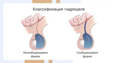 Гигантская скользящая пахово-мошоночная грыжа мочевого пузыря