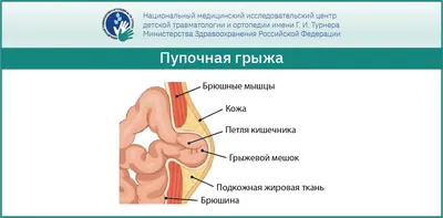 Паховая грыжа