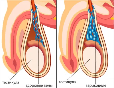 Паховая грыжа | zdrav.kz