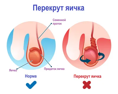 K40.0 Паховая грыжа | Описание болезни, диагностика, лечение