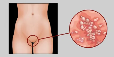Болезни любви: чем опасен половой герпес | Zdorovieinfo.ru | Дзен