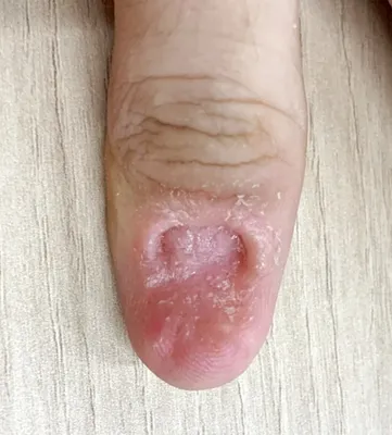 Пальцы без ногтей фото фото