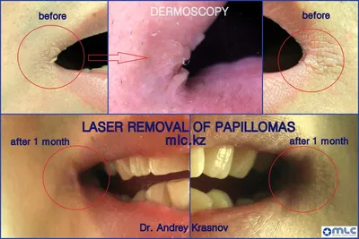 🥇 Удаление папиллом, бородавок и кондилом лазером по выгодной цене в  Алматы | MLC