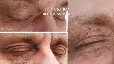 Лазерное удаление папиллом, фибром в Brenner Laser Clinic