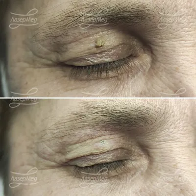 Эстетические удаления образований кожи на веках — nevus.pro