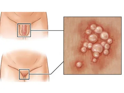 Кондилома: лечение, симптомы, виды, профилактика, причины и последствия  заболевания