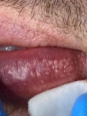 Киста половой губы: причины, симптомы, диагностика, лечение, операция в  клинике «АльтраВита»
