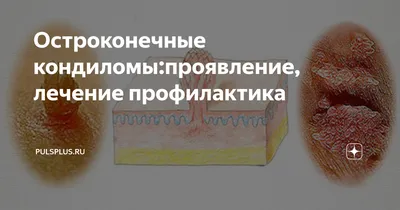 Папилломы и бородавки в интимном месте: риски, советы, удаление