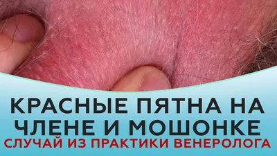 Папилломы на гениталиях - как вести половую жизнь с ВПЧ? | Лазерсвiт в  Одессе