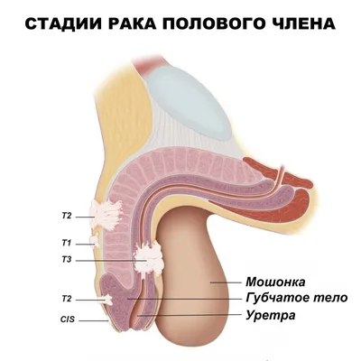 Рак полового члена: симптомы, признаки, диагностика, лечение