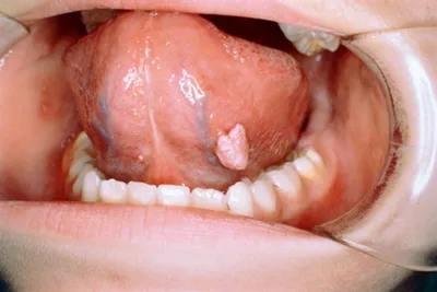 Лечение заболеваний слизистой оболочки полости рта в Кисловодске - клиника  \"Современная стоматология\"