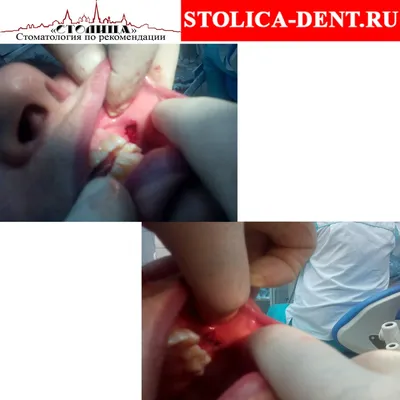 Болезнь Хека или фокальная эпителиальная гиперплазия - parodont.pro