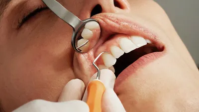 Что нужно знать о раке полости рта | Стоматология ROOTT | Дзен