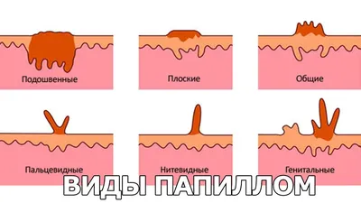 Папилломы на интимных местах - причины, симптомы, диагностика, лечение и  профилактика